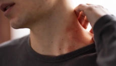 Risiken und Prävention von Windpocken zum zweiten Mal bei Erwachsenen